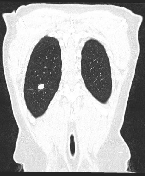 3. Localizált betegség Diagnosztikus lehetőségek: Köpet cytologia