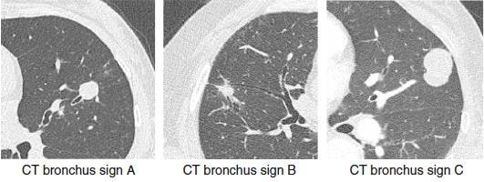 Sensitivitás A bronchus sign