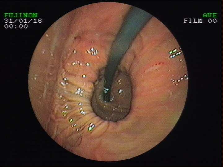 Hiatus hernia (rekesz sérv) Tünetei: 1. testhelyzet, cipőfűző tünet 2.