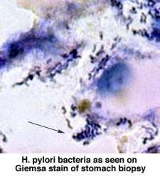 Helicobacter Pylori 1983: Marshall & Warren spirál alakú, microaerophil baktérium világ lakosságának több mint felében megtalálható (sok a hordozó) gyomor