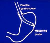 idegentest eltávolítható, biopsia végezhető Gastroscopia 96