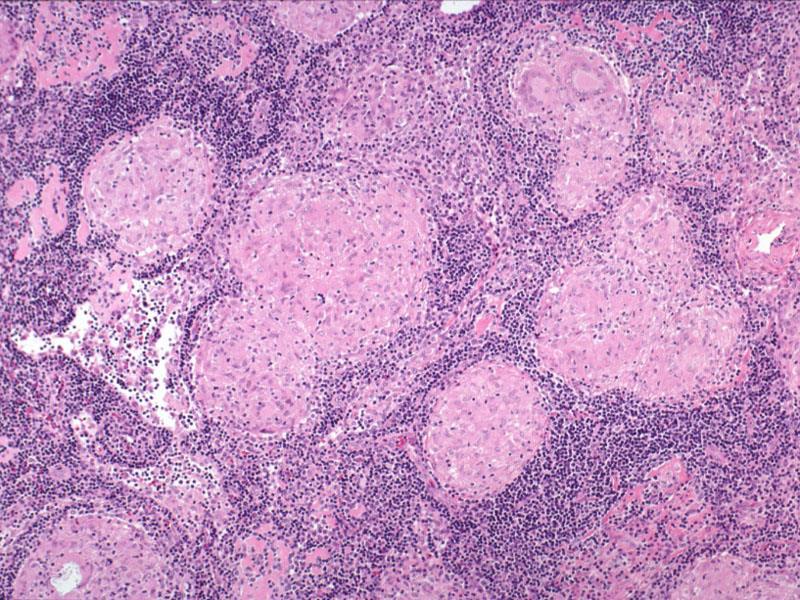 Sarcoidosis (Type IV.