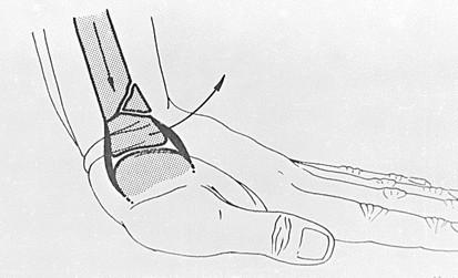 palmaris lejtés: 10-14 o A radius distalis ízületi vég 3D CT képe Általános megjegyzés: a leggyakoribb törés (15%), mindenkinek ismernie kell Oka: