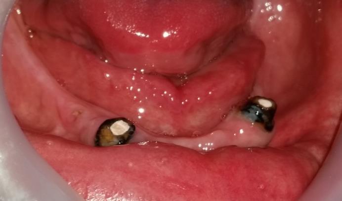 Státusz Felső állcsont: 1B osztály Overdenture (18 éves) Stéggel egybeöntött fém koronák, pillér fogak: 17,13,23,26,27 17: secunder caries 13: