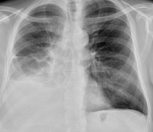 Első vonalbeli kezelés 2015. augusztus 10: Onkoteam döntése alapján: T1bN2M1a stádium, ECOG:0 beteg Paclitaxel+carboplatin+bevacizumab terápia javasolt.