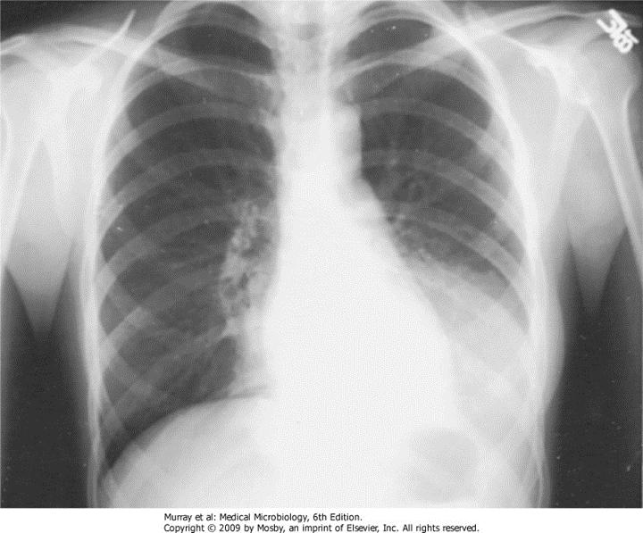 egyharmadát a pneumococcus okozza Tokos, megnyúlt lángnyelv vagy dárdahegyszerű diplococcus Tok alapján 90 típus: a