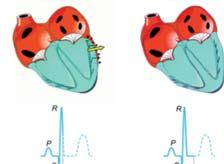 pulmonalis Jobb kamra Idő A bal kamra nyomás-térfogat