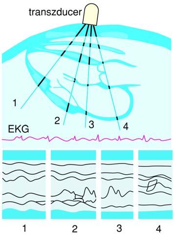 TM kép (Time Motion) TM-kép B-kép EKG jel refereniaként (függőleges) egydimenziós B-kép időbeli változása idő (T)M-kép Time Motion Tkv. VIII.34.