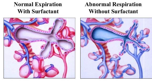 Surfactant hiány (< 34. gest.