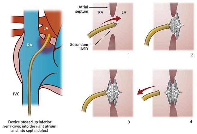 shunt Fossa ovalis