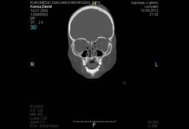 Zárt CF +/- zárt TON Nyitott CF +/- nyitott TON Zárt koponyatörés: hajas fejbőr sérülése nélkül koponya csont sérülése nélkül Nyitott koponyatörés: a hajas fejbőr destruktív léziója infekció veszélye