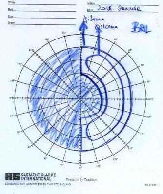 6 CFF: 37-28 Hz 1 meter ujjolvasás a nasalis látótérben Fundus: normal