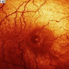 macula) +/- perifériás látótér defektus (centrális látás-megkíméltséggel) társuló neurológiai