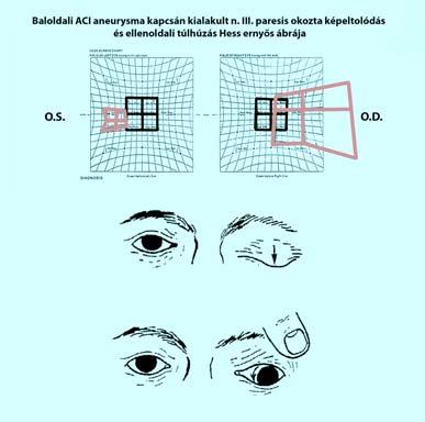 A perifériás nervus oculomotorius paresis Jellemzői: +/- (in)komplett ptosis abdukcióban vagy kifelé lefelé rögzült anisocoria indirekt pupillomotoros
