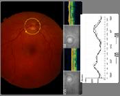 oheidelberg Retina Tomográfia (HRT)