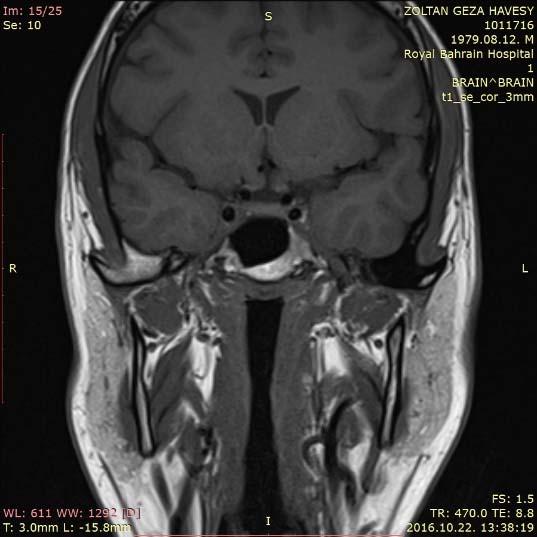Tolosa-Hunt szindróma diagnosztikus kritériumok (International Headache Society 2004) kezdeti tünetek: o féloldali fejfájás o egyoldali szemgolyóba sugárzó szemfájdalom o intermittáló diplopia,
