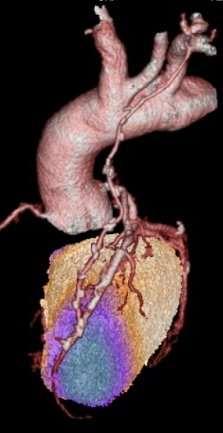 3D SPECT/CT felvétel: a circumflexa végső szakaszának