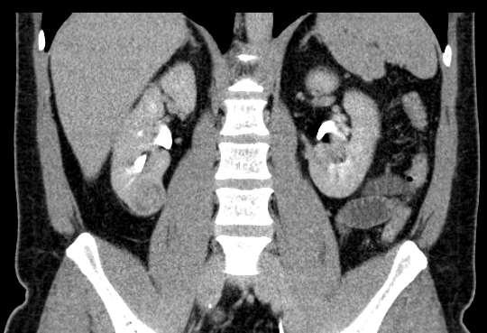 SPECT- CT) mindig urographiás fázissal kiegészítve, rekonstrukciókkal műtéti tervezéshez, kiválasztásos urographia kiváltására