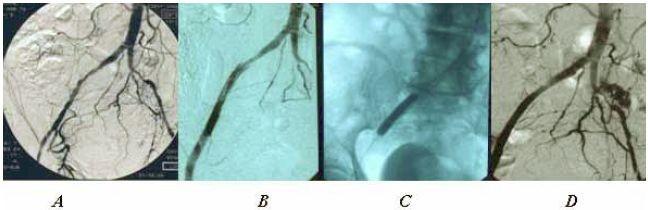 5. ábra. A: preoperatív morphológia. B: hagyományos Vollmar TEA kontroll angiographia: részleges proximális dissectio, reziduális stenosis. C: stent depozíció. D: jó eredmény.