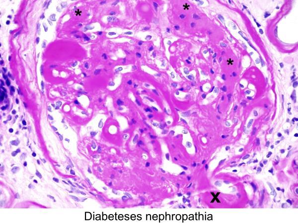 Vesebiopszia Az IF és FM vizsgálat során immunkomplex glomerulonephritis nem