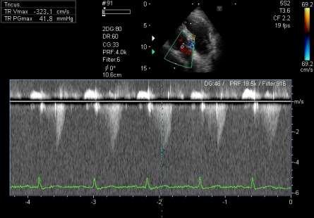 Echocardiográfia, Swan-Ganz katéterezés 1.eset 2.