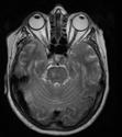 Adott beteg agysérülésének pontos felmérése. Strukturális elváltozások kapcsolata neurológiai, pszichiátriai tünetekkel. http://wsunews.wsu.edu/content/p ublications/mri1.jpg http://wsunews.wsu.edu/content/p ublications/mri_neuro1.