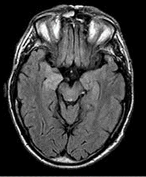 limbicus encephalitisek A neuronok felszíni receptorai ellenes antitestek által kiváltott encephalitisek jellemzően a mediobasalis limbicus struktúrákat érintik, ezért limbicus encephalitisek -ként