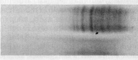 paraneoplastic neurologi