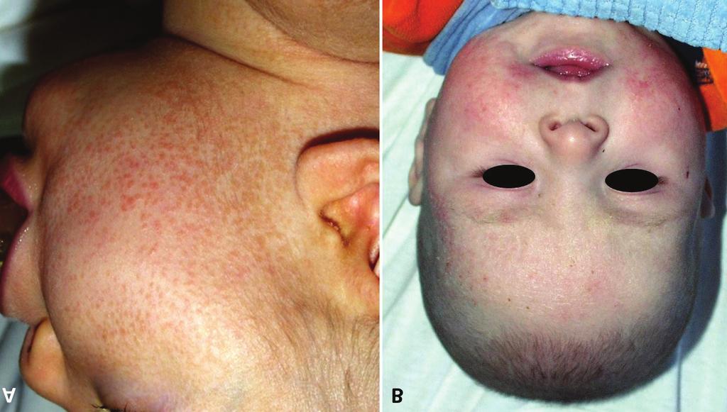 1. ábra A) Seborrhoeás dermatitis klinikai képe.