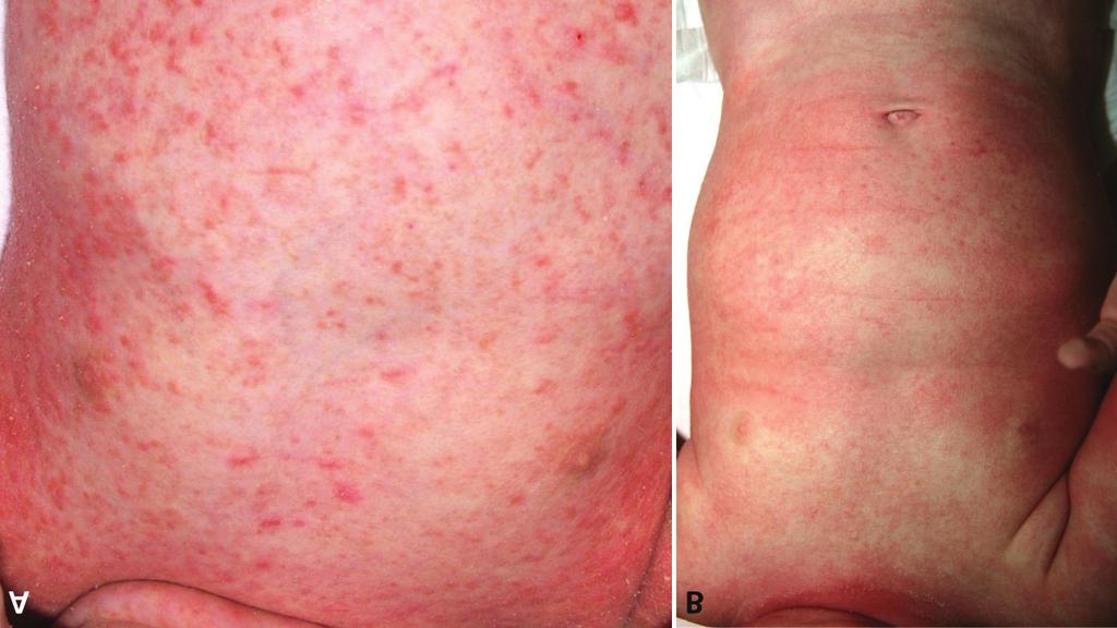 B) Atópiás dermatitis csecsemőkori klinikai képe (Források: DE Bőrgyógyászati Klinika fotógyűjteménye) erythroderma formájában megjelenő mycosis fungoides (4.