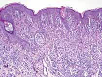 dermális, funkcionálisan inaktív sejtpopuláció negatív (4 ); c) PNL-2-vel a
