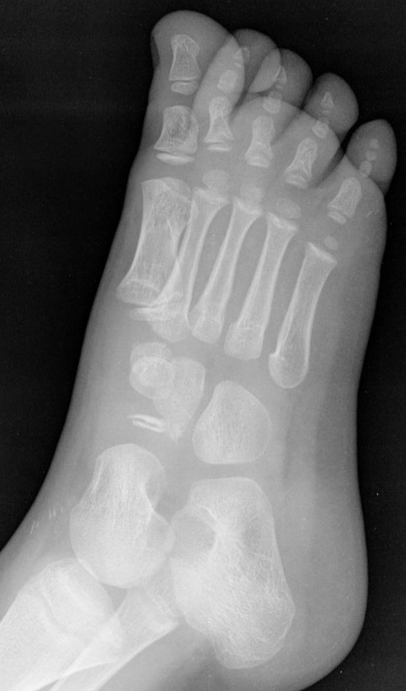 B3. ábra: Irreguláris csontosodás Köhler betegség, vagy variáció? A felső képeken egy öt fiú felvételei láthatóak. A lelet véleménye az alábbi volt: Lelet: A os cuneiformde III.