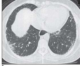 légzésfunkciós teszt HRCT Tc scan -