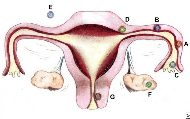 Tubaris terhesség A megtermékenyített pete megtelepedhet a cervixben, a méhkürtben, a petevezetőben és a hasüregben is.