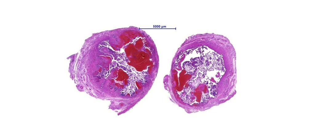 Extrauterin graviditás - mikroszkópia Placenta szöveti elemek: magzatboholy, decidua,