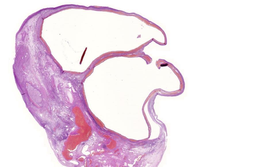 Follicularis ovariumcysta Meg nem repedt