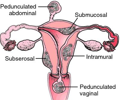 Daganatok: uterus test Simaizom eredetű: leiomyoma és