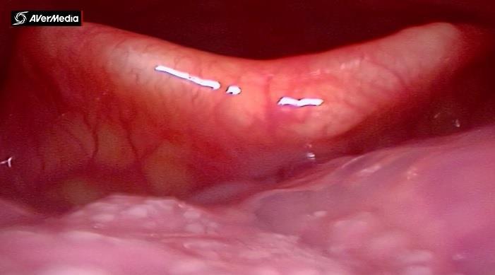 fiberoscopia): nyelvgyök, vallecula