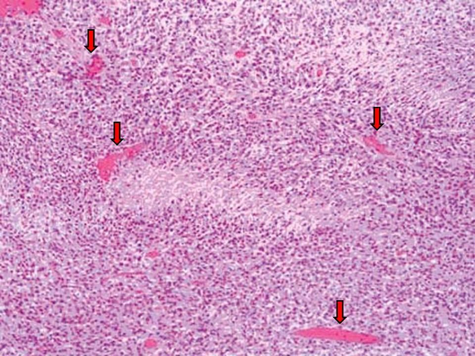 2.2. A glioblastoma szövettani jellemzői A WHO 2007 óta szövettani jellegzetességeik szerint négy grádiusba osztja a gliomákat (grade I-IV).