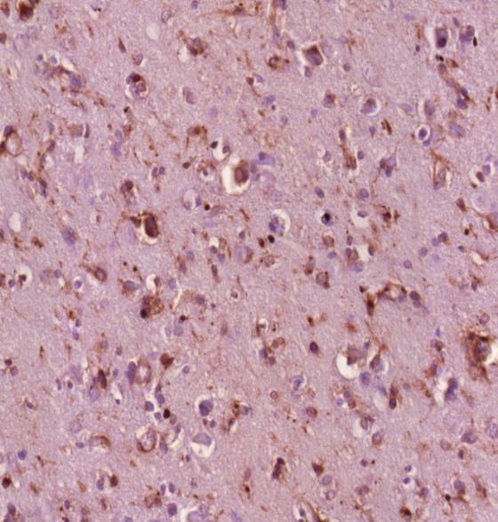 anyagból származó IHC képen, ami valószínűleg inkább a két tumor biológiai természetével, mint a minták különböző eredetével áll összefüggésben.