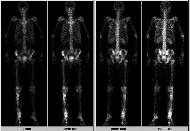 Osteomyelitis