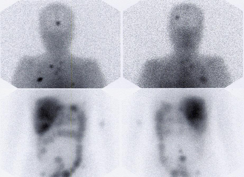 Pancreasfej carcinoid