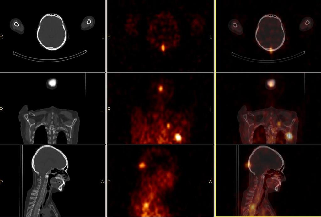 Pancreasfej carcinoid