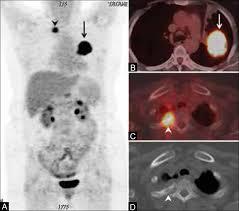 FDG PET-CT, Tüdő