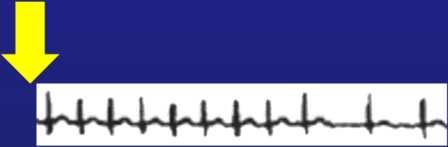 Aktiválás módja Nincs aktiválás Folyamatos felvétel Ágy melletti monitor Telemetria Holter Paciens aktiválás Paciens aktiválás + Arrhythmia