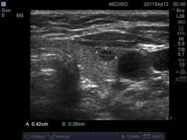 Mellékpajzsmirigy adenoma Lokalizáció, izotópos vizsgálat ( MIBI SPECT ) Megfelelő