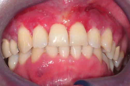 A páciens szuper puha fogkefével már tudott fogat mosni, azonban általános rossz közérzete nem javult és a jobb alsó szemfog környékén a gingiva minimális mértékben ismételten megduzzadt és vörhenyes