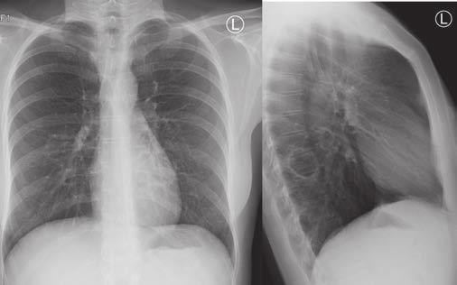 FOGORVOSI SZEMLE 110. évf. 3. sz. 2017. 101 15. ábra: A február közepén elvégzett röntgenkontroll eredménye szerint a tüdőstatus javult. Jobb oldalon dorsalisan kb.