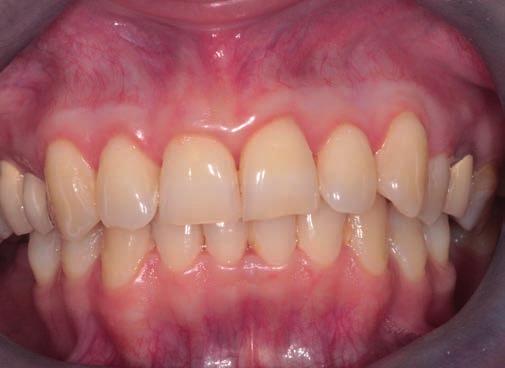 A cyclophsophamid kezelés havonta egy alkalommal folyik tovább. A páciens március 14-én jelent meg parodontális kontrollvizsgálaton.