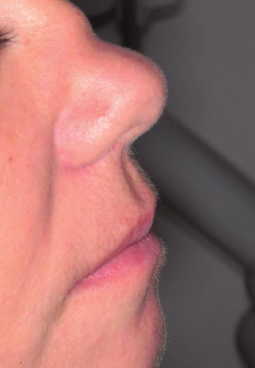 Az egyedüli maxillofaciális eltérést a jelentős mértékben besüppedt orr nyereg jelenti, amelynek későbbi plasztikai korrekciója szóba jöhet (16. ábra a, b).